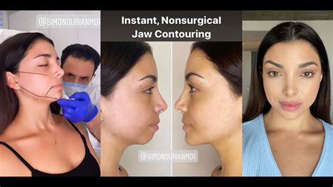 JAWLINE AND CHIN CONTOUR WITH FILLER | BEFORE AND AFTER | Dr. SimonOurian - YouTube