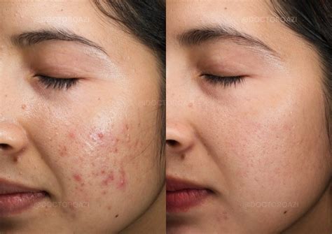 What is Active Acne: Types, Causes, and Treatment Options