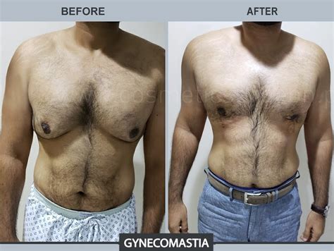 Gyno - Gynecomastia Surgery, Treatment & Causes - Flashy Info