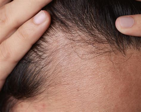 Premature Men Hair Loss: prevention solutions to start now