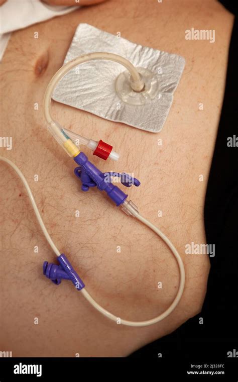 Percutaneous endoscopic gastrostomy (PEG) is an endoscopic medical procedure in which a tube ...