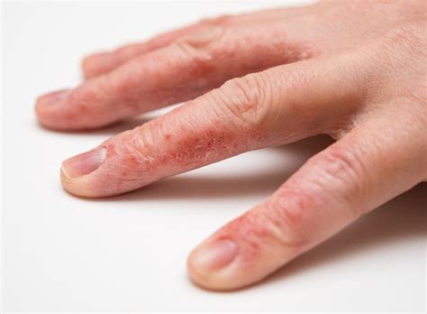 Types Of Eczema On Palms Of Hands - BEST GAMES WALKTHROUGH