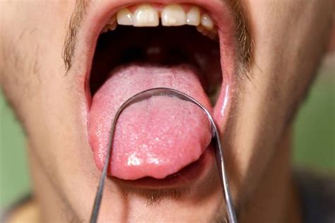 How to Get Rid of Vape Tongue - Kine Magazine