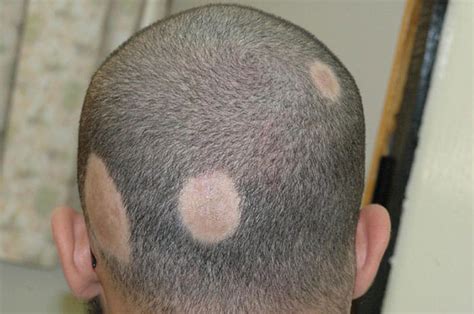 alopecia areata for men - HairFibers.com