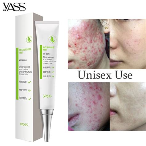 Herbal Acne Cream Anti Pimple Spot Acne Scars Blackhead Removal Cream Whitening Beauty Skin Face ...