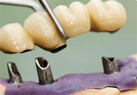 Single Tooth Dental Implant | Asia Pacific Dental Centre