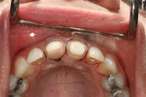 Avoid Cutting the Cingulum from Anterior Teeth | CDOCS