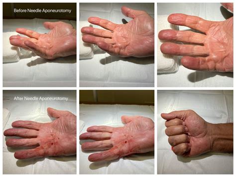 dupuytren's contracture radiation treatment - slevaarujo