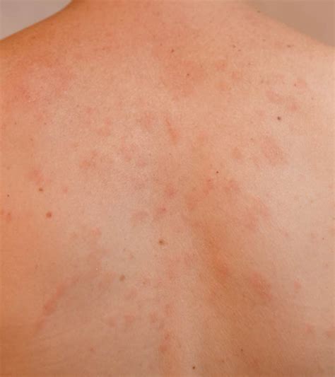 Pityriasis Rosea: Stages, Photos, Treatments, 51% OFF