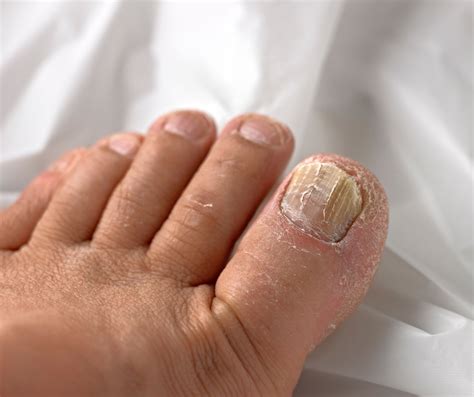 Best Treatment For Dry Brittle Toenails | edu.svet.gob.gt