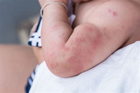 17 Most Common Types of Baby Rashes (With Pictures)