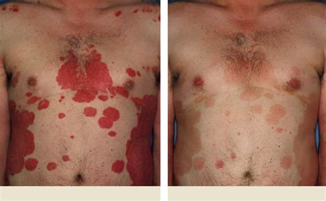 Plaque Psoriasis Pictures Before & After HUMIRA® (adalimumab)