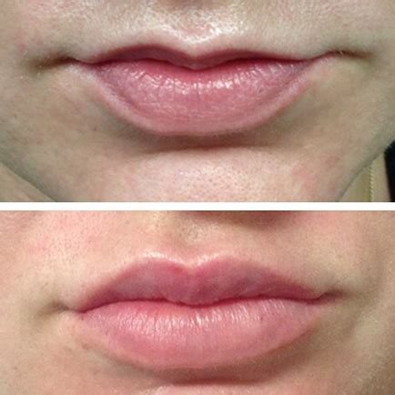 Restylane On Lips Before And After | Lipstutorial.org