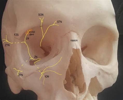 Surgical Management of Post-Traumatic Trigeminal Neuralgia – Case Report and Review of the ...