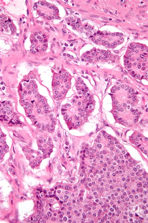 File:Small intestine neuroendocrine tumour high mag.jpg - Wikipedia ...