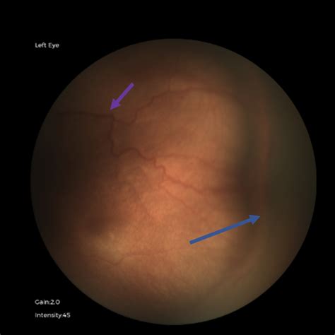 Peds Ophtho Case 4: Dilated Fundus Exam