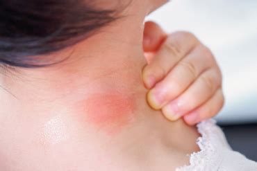 Tiger mosquito bite: what symptoms does it cause - Home Health Care