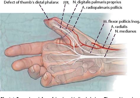 Reconstruction of the thumb tip using palmar neurovascular flaps ...