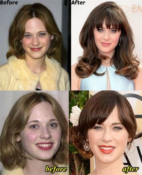 Zooey Deschanel's Plastic Surgery: Nose Job, Lip Fillers, Brow Lift, Botox!