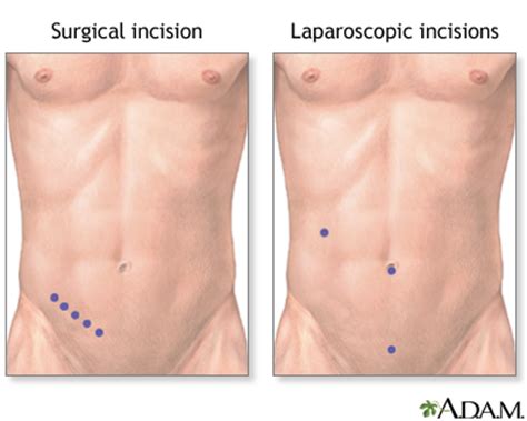 Appendectomy - series—Incision: MedlinePlus Medical Encyclopedia