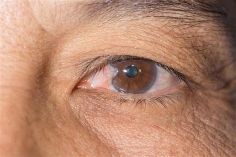 Common Eye Diseases: List of Most Common Eye Diseases in India, Symptoms & Treatment