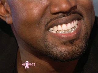 Kanye West Teeth Before And After Photos; Kanye West Replaces His ...