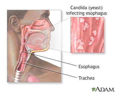 Herpes Esophagitis