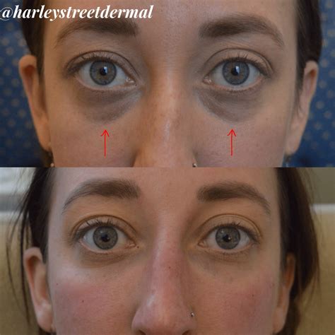 Dark Circles Treatment in London | Harley Street Dermal