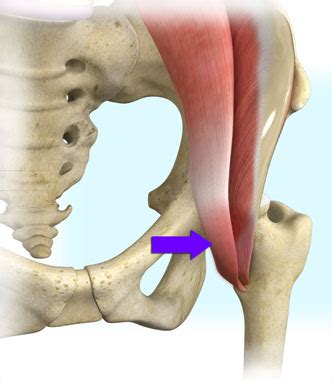 Iliopsoas tendonitis after hip replacement | doctorvisit