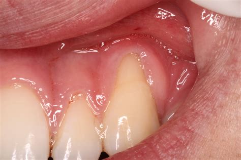 Different treatments for gum recession - Ryan Lanman DDS, MSD