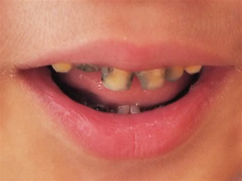 Rotten Teeth - Causes, Symptoms, and Treatments - PRV Dental