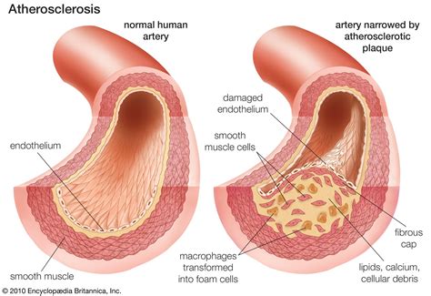 Atherosclerosis Diagram