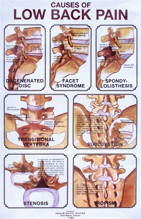 Causes of Low Back Pain