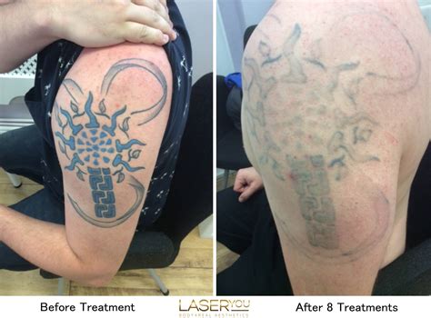 picosure laser tattoo removal reviews - Father Vodcast Picture Gallery