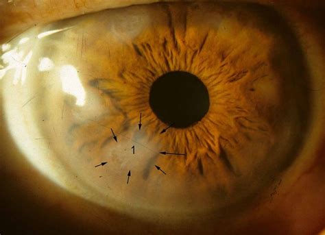 Ocular Pathology: Salzmann’s Nodular Degeneration of the Cornea Eye ...