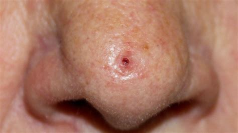 Melanoma Inside Nose