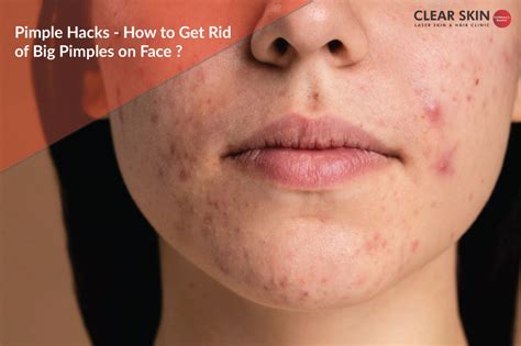 Pimple Hacks - How to Get Rid of Big Pimples on Face