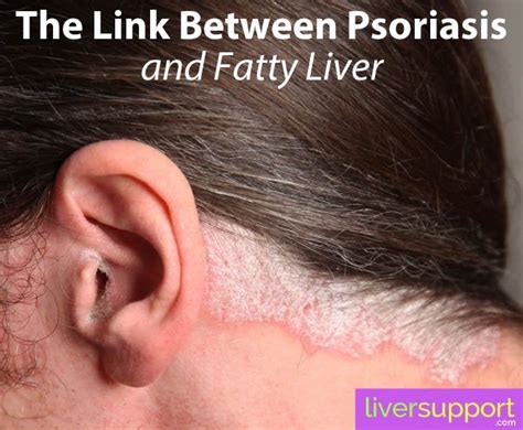 Pin on Liver Health News