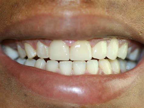 Porcelain crowns used to restore a smile in Indianapolis.