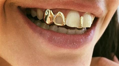 What are Dental Grills and Is It Safe to Use Them?