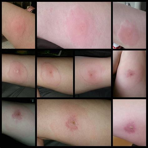 These pictures of the most common spider bites will help you figure out what kind of spider bit ...