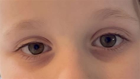 Dark circles under the eyes in kids – The Island News – Beaufort, SC