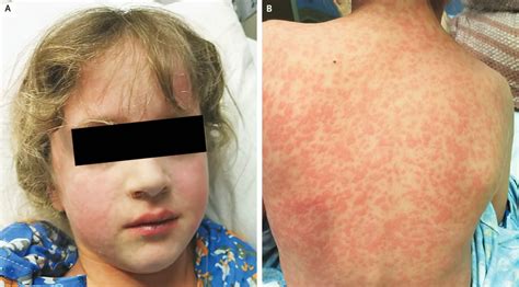 Amoxicillin rash in 7-year-old with infectious mononucleosis