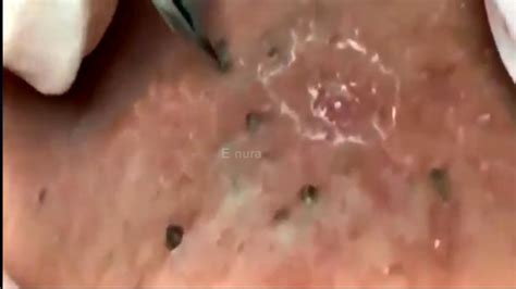 blackhead extractions new | remove blackheads dermatologist 35 - YouTube