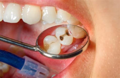 How Do Dentists Fix Cavities?｜Oakville