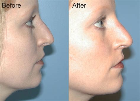 Nose Procedures in San Diego, La Jolla, Murrieta, CA | RevivaMed Plastic Surgery