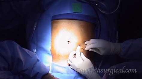 Appendectomy for ruptured appendicitis - YouTube