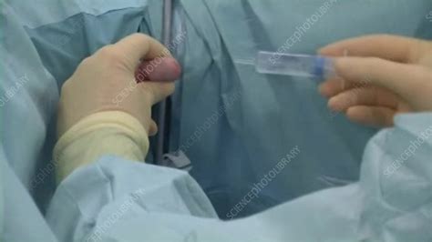 TURP biopsy procedure - Stock Video Clip - K003/8579 - Science Photo Library