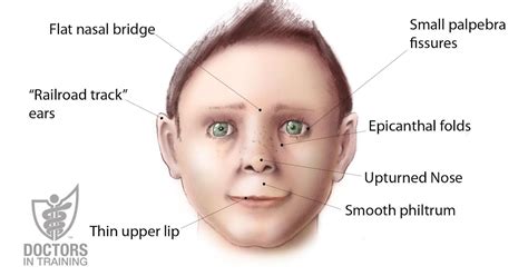 Flat Nasal Bridge And Epicanthal Folds - BK Plastic Surgery: BK Plastic Surgery Non-surgical ...