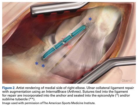 Ulnar Collateral Ligament Reconstruction: Current Philosophy in 2016 | MDedge Surgery